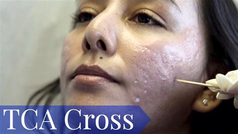 Tca Cross For Deep Acne Scars For Olive Skin Tone Part One Youtube