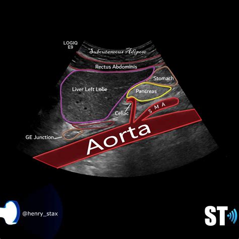 Liver Anatomy And Protocol Basics Sonographic Tendencies Medical Ultrasound Diagnostic