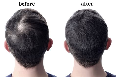 Progression Of Hair Loss In Men Darling Hair Restoration