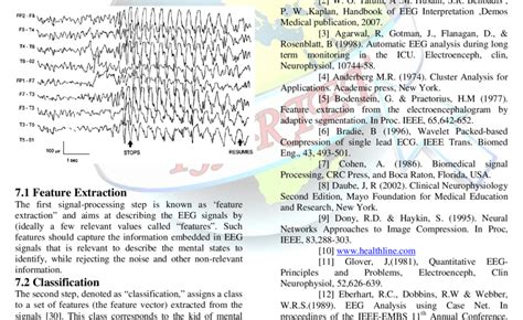 Electroencephalogram Demonstrating Benign Rolandic Epilepsy Note The