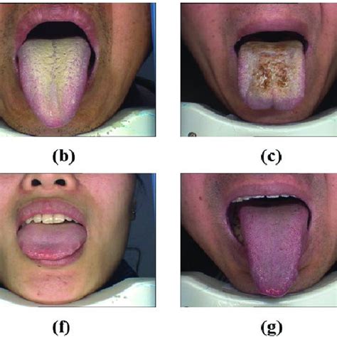 Samples Of Tongue Image Dataset Download Scientific Diagram