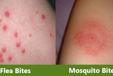 Flea Bites That Look Like Mosquito Bites While Mosquitoes Don T Have