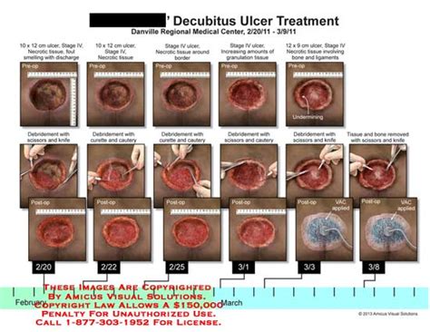 Decubitus Ulcer Staging Hrf Vrogue Co