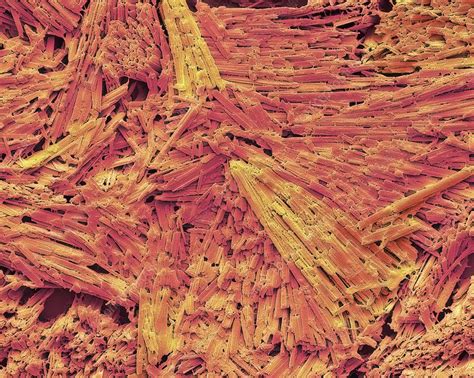 Uric Acid Crystals In Gout SEM Stock Image F Science Photo Library