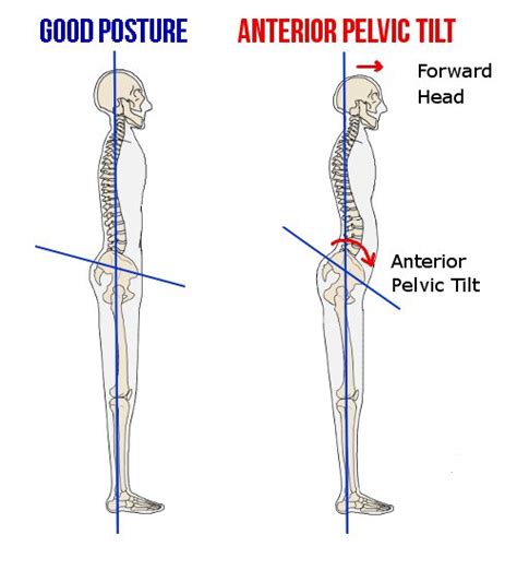 Anterior Pelvic Tilt And Flat Feet