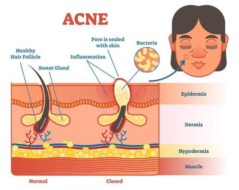 Acne Eliminating Your Acne Key Plans For Clearing Your Acne Skin