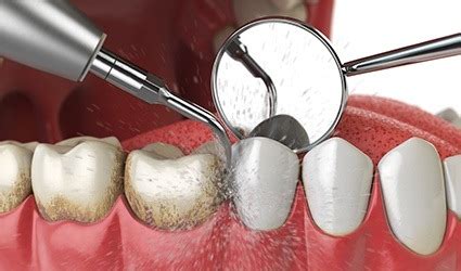 Scaling a tooth by a dentist will go a long way in removing these stains, but before deciding to scale a tooth, be sure to see your dentist. Professional Teeth Cleanings Park City, UT | Oral Health ...
