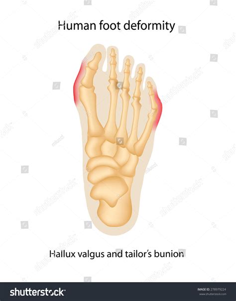 Human Foot Deformity Hallux Valgus Tailors Vector De Stock Libre De