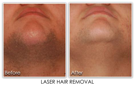 Laser Hair Removal For Men Archives Skin Rejuvenation Clinic Skin