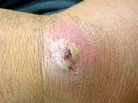 Deadly Skin Infection 12 Graphic Photos That Could Save Your Life