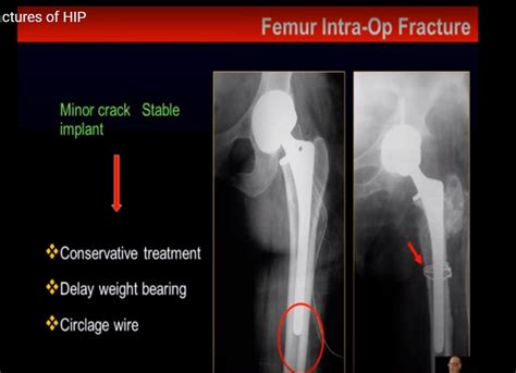 Periprosthetic Fractures Around The Hip —