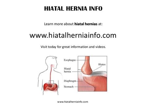 Hiatal Hernia Info