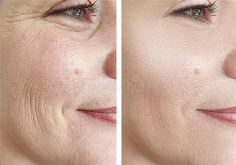 Woman Wrinkles Face Before And After Rejuvenation Cosmetology