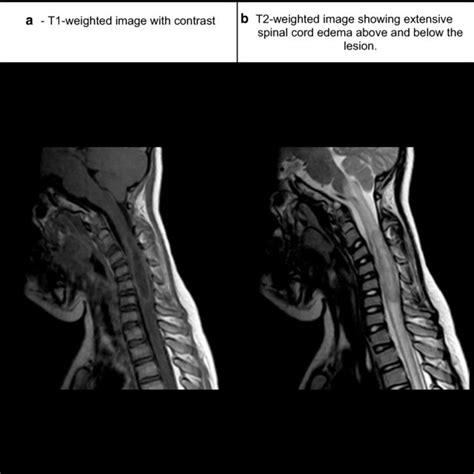 Preoperative Sagittal MRI Of The Cervical Spinal Cord A T1 Weighted