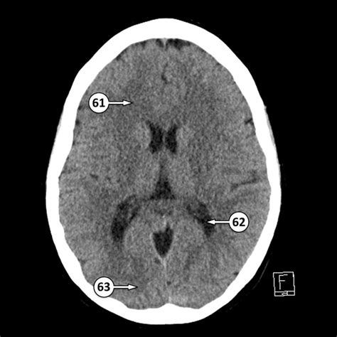 Lateral Ventricle Anatomy