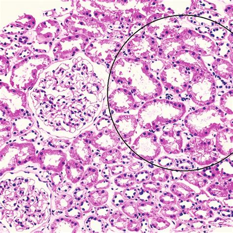 Renal Biopsy Findings In Acute Tubular Necrosis In Contrast The