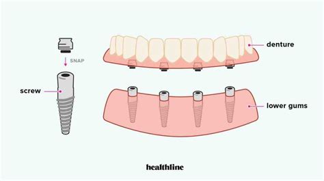 When Is The Best Time To Put Dental Implant In Right After Tooth