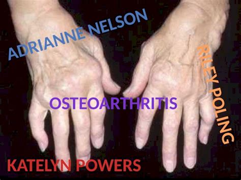 Pptx Called The Wear And Tear Arthritis Osteoarthritis Is The Most