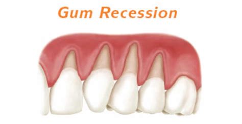 What Is Gum Recession And How Can It Be Treated Harmony Dental