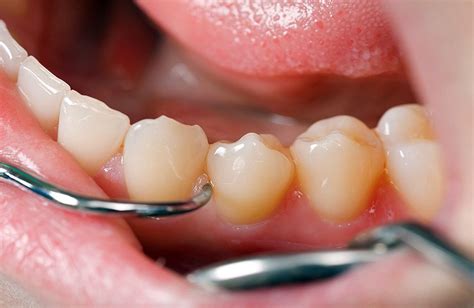 Curetaje Dental ¿qué Es Y Cómo Se Realiza