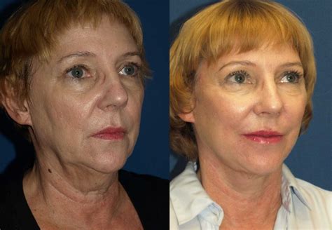 Fat Transfer To Face San Diego Golden Triangle Plastic Surgery