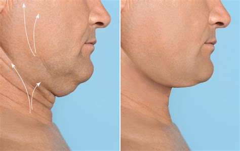 Neck Lift In New Jersey Male Plastic Surgery Glasgold Group