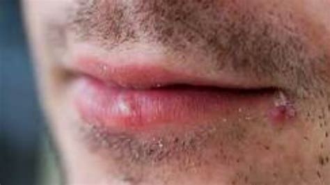 How To Get Rid Of Cold Sores On The Side Of Your Mouth Youtube