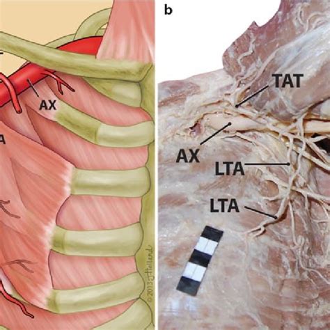 A Type I Lateral Thoracic Branches Lta Of The Thoracoacromial Artery