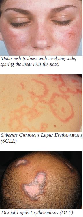 Connecting Rheumatology And Dermatology To Diagnose And Treat