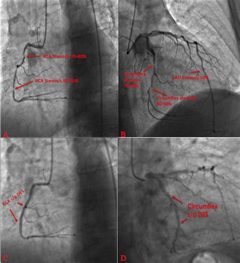 Cardiac Catheterization