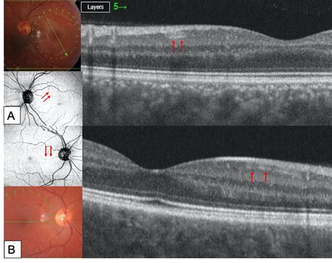 Retinal microvascular abnormalities in patients after 