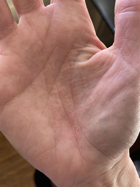 Is This Rash On My Palm A Celiac Symptom Rceliac