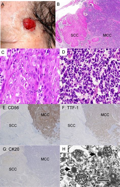 Merkel Cell Carcinoma With Cytokeratin 20 Negative And Thyroid