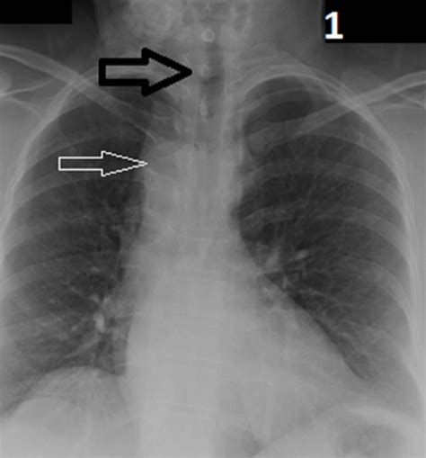 Aortic Arch Chest X Ray