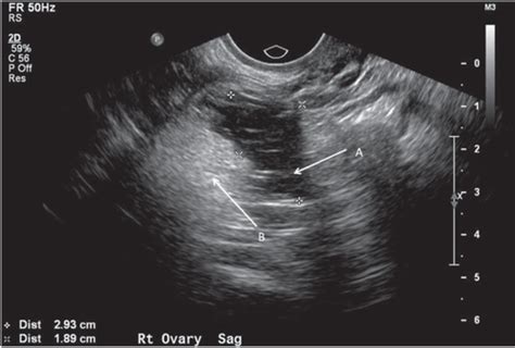 Ovarian Dermoid Cyst Ultrasound