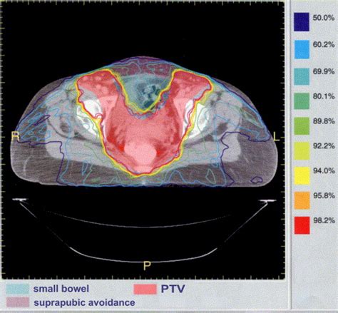 intensity modulated radiation therapy imrt in the treatment of anal cancer toxicity and