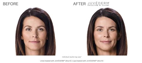 Juvéderm Before And After