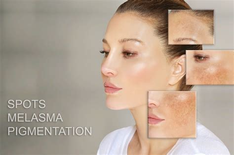 Melasma Vs Hyperpigmentation Whats The Difference Charette Cosmetics