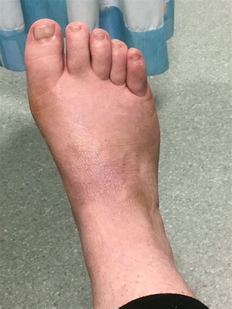 Bone Spur On Top Of Foot Surgery Recovery Rayne Frye