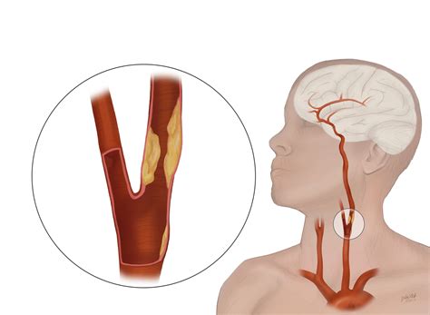 In the neck, each of them branches off into an internal carotid artery. Carotid Artery Disease | Johns Hopkins Medicine