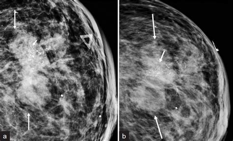 Review Of Metaplastic Carcinoma Of The Breast Imaging Findings And