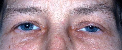 A Primer On Ptosis