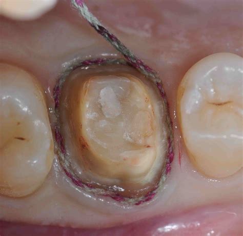 Treating Cracked Tooth Syndrome The Diagnostic Provisional Lee Ann