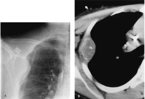 Diseases Of The Chest Wall And Diaphragm Radiology Key