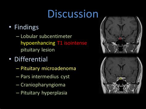 Pituitary Gland Cyst Mri