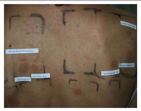Figure 4 From Allergic Contact Dermatitis Caused By Formaldehyde And