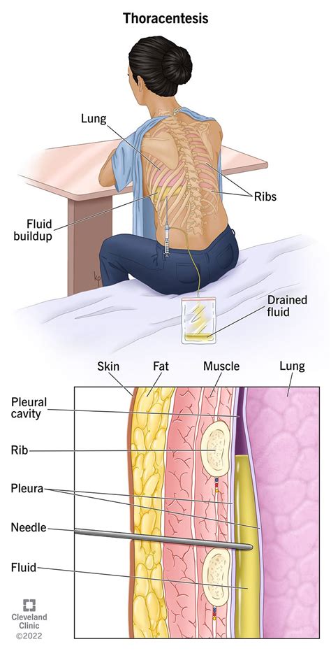 Thoracentesis Purpose Procedure Risks Recovery