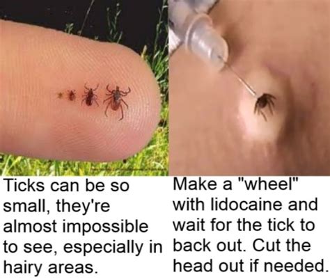 New Tricks For Removing Ticks Tick Removal Ticks Tick Bite