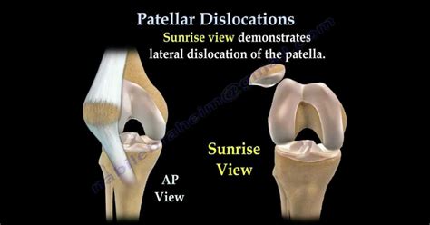 Recurrent Dislocation Patella Dnb Orthopaedics Ms Orthopedics Mrcs