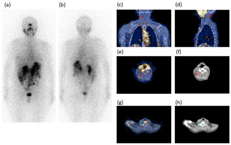 Radioactive Iodine Scan